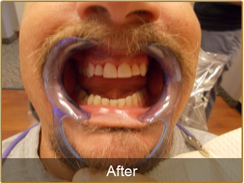  Teeth Deep Cleaning Before and After