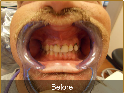  Teeth Deep Cleaning Before and After